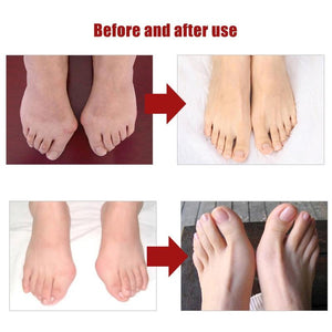 1Pair Silicone Toes Separator Bunion Bone Corrector
